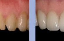 Veneer option for better smile