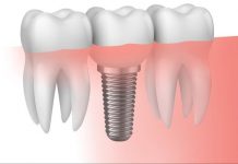 Benefits of dental implants